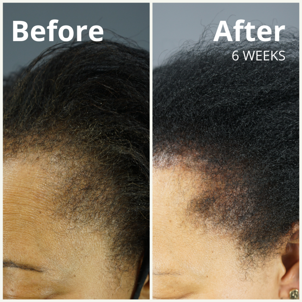 GASHEE Hair Stories: 6 Weeks to Better Edges With Natural Growth – Gashee