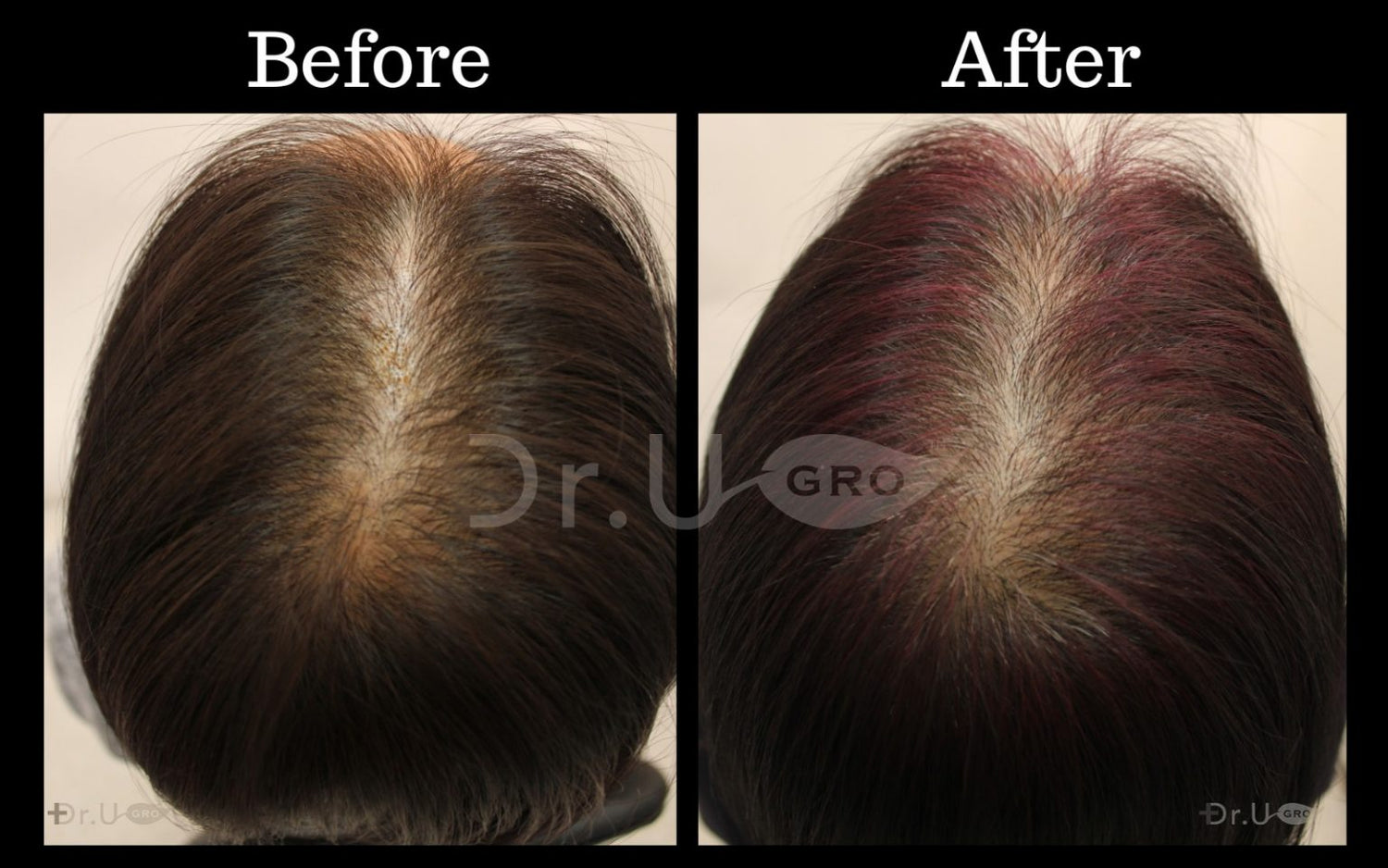 GASHEE Hair Stories: Doctor-Approved Hair Growth Results