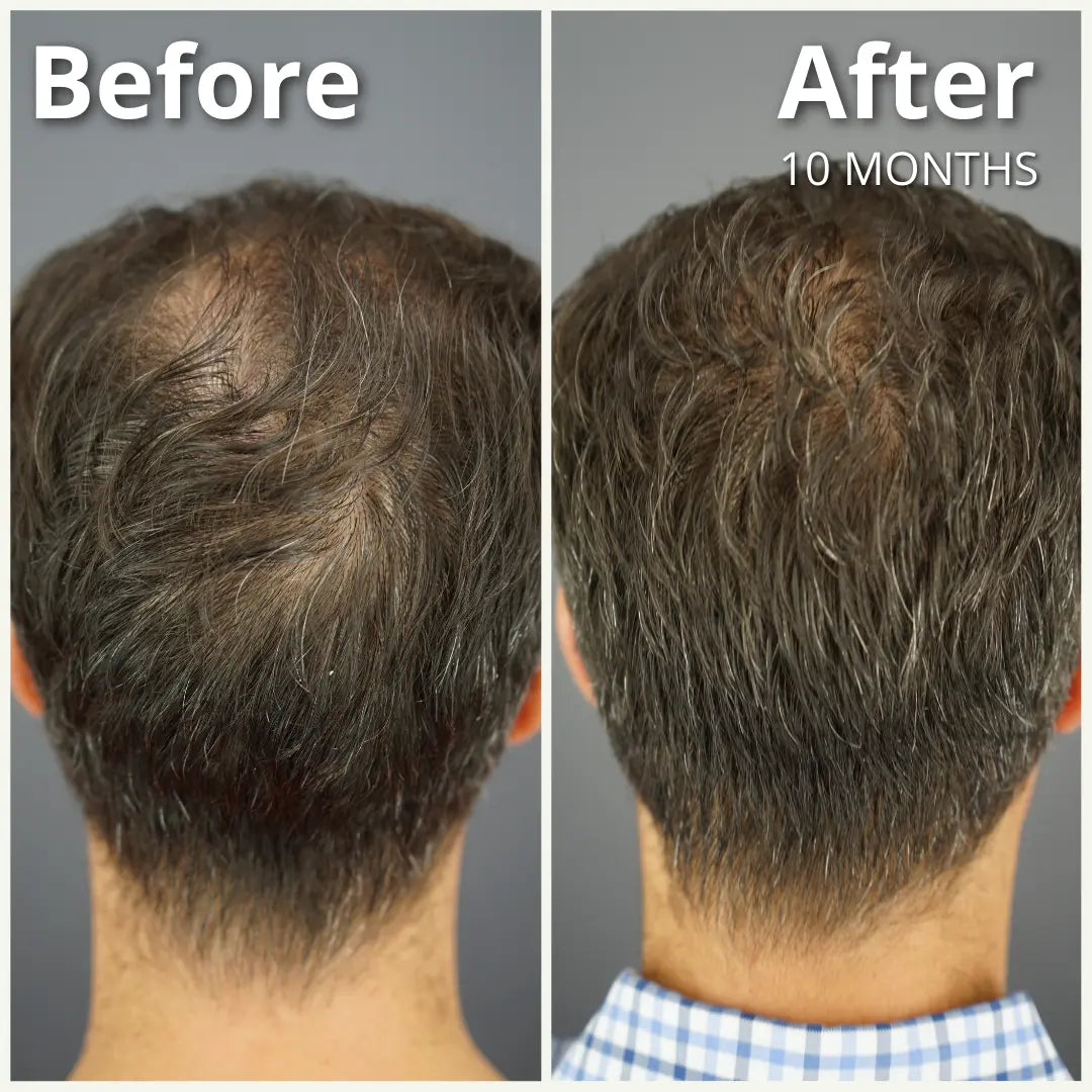 GASHEE Hair Stories: Stop Men’s Hair Loss with GASHEE