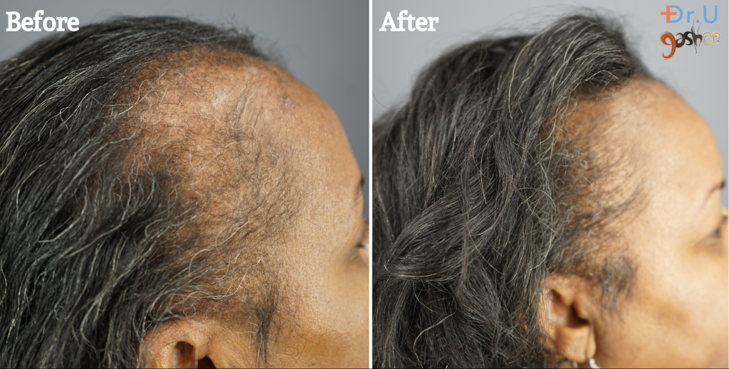 Remarkable Hair Growth and Restoration: A Journey with Gashee