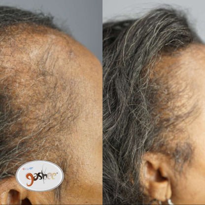 Before_and_after_gasheen_real_patient.jpg